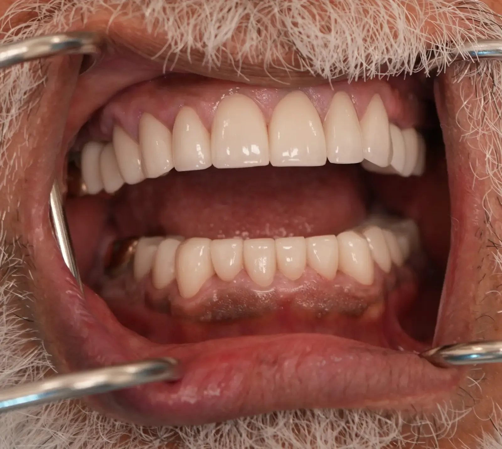 After dental treatment photo for patient 1