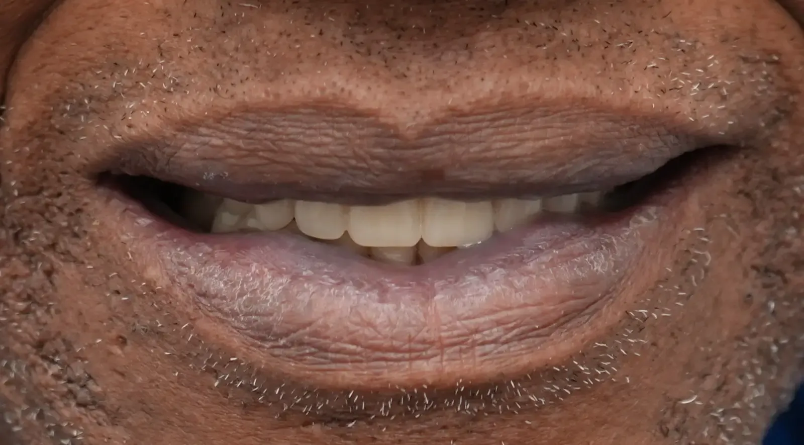 After dental treatment photo for patient 2