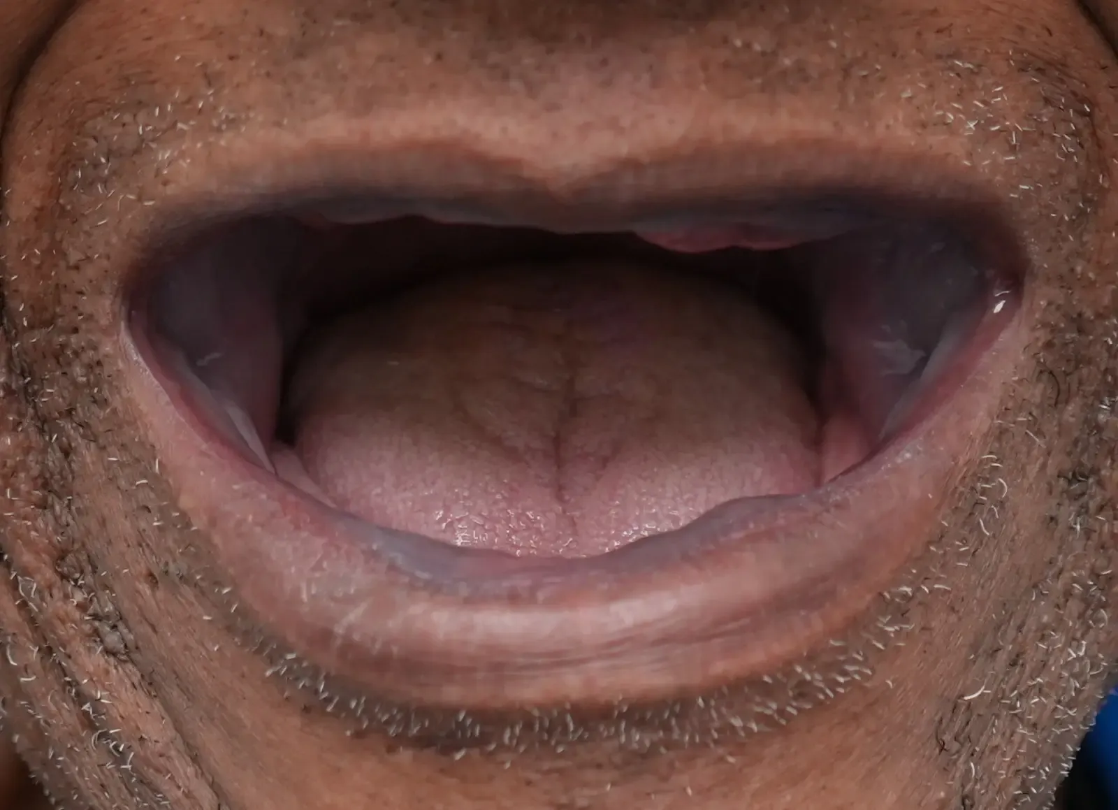 Before dental treatment photo for patient 2
