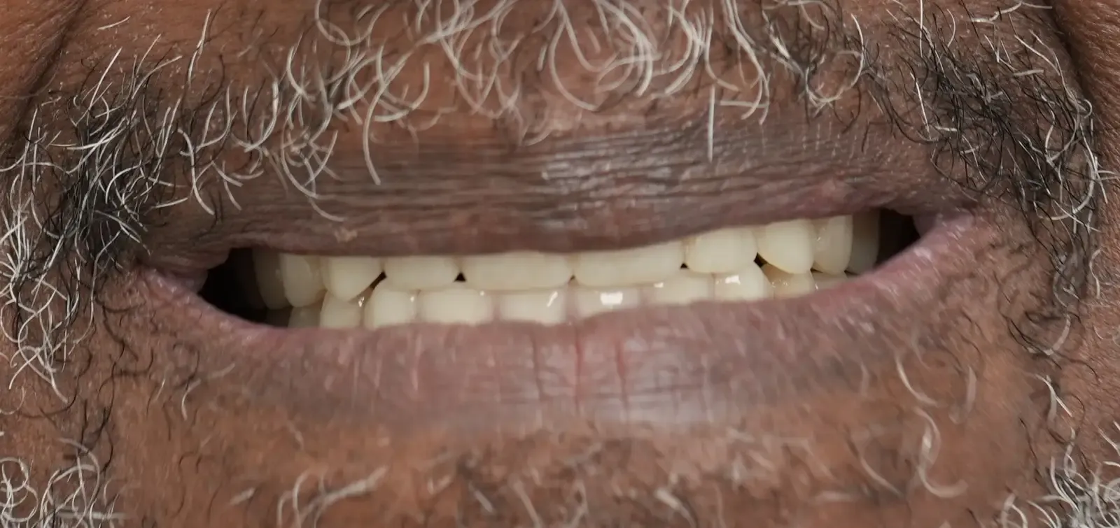 After dental treatment photo for patient 3