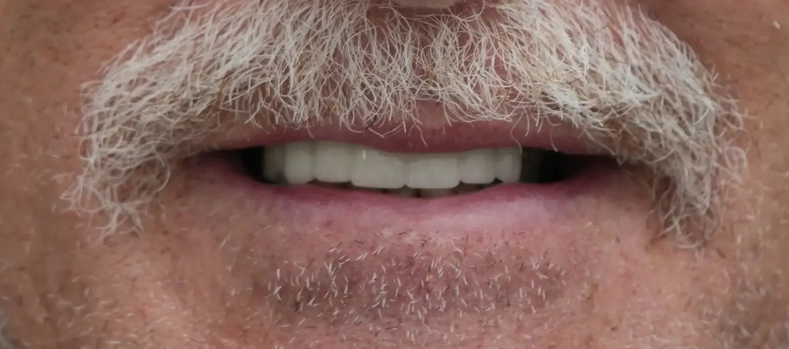 After dental treatment photo for patient 4