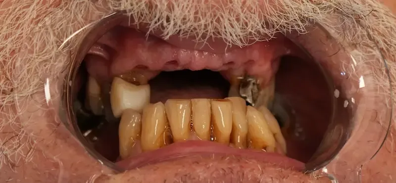 Before dental treatment photo for patient 4