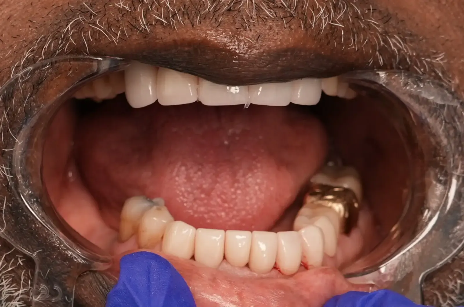After dental treatment photo for patient 5