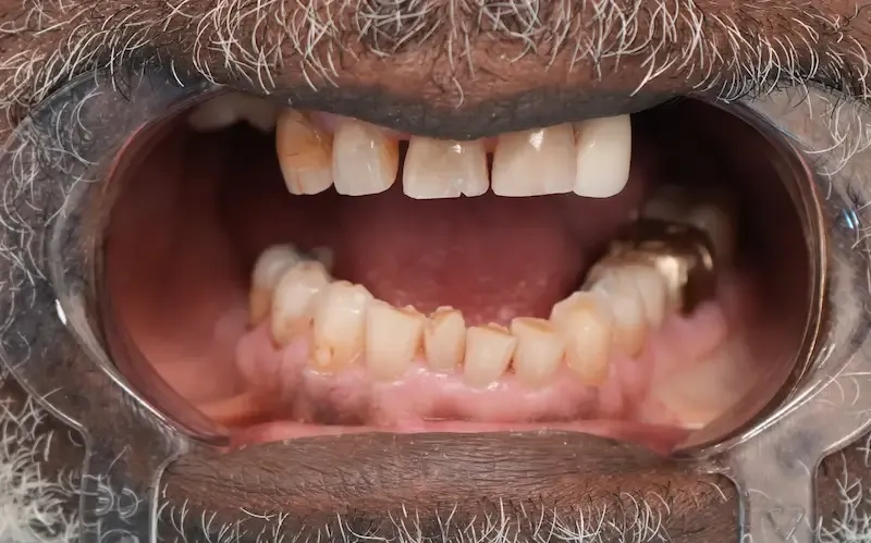 Before dental treatment photo for patient 5