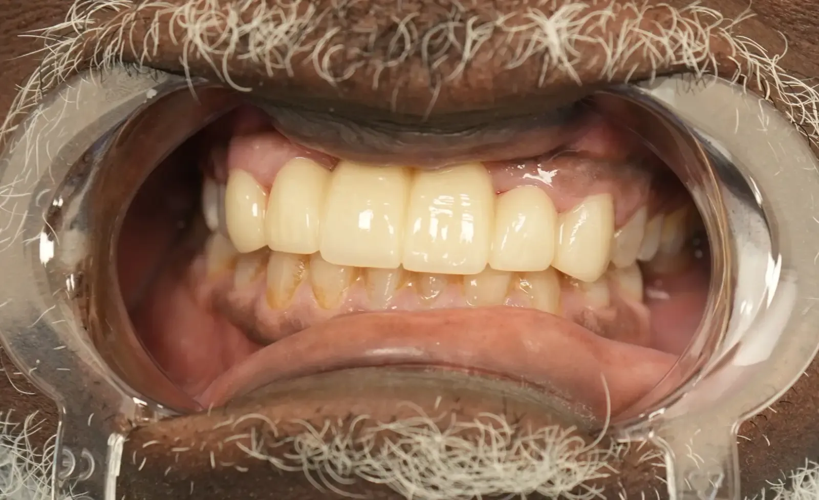After dental treatment photo for patient 6
