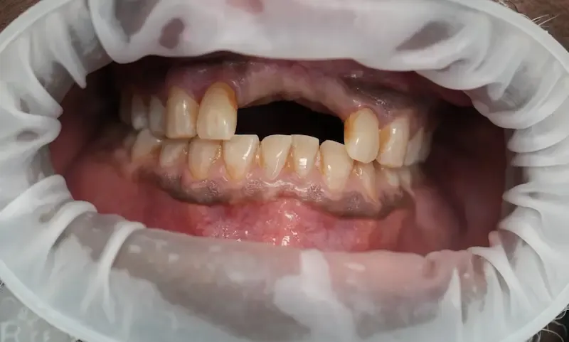 Before dental treatment photo for patient 6